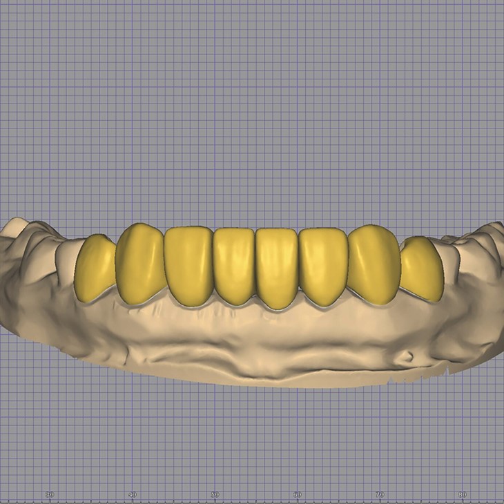Dental Digital Mutilunit Veneer Design suppliers