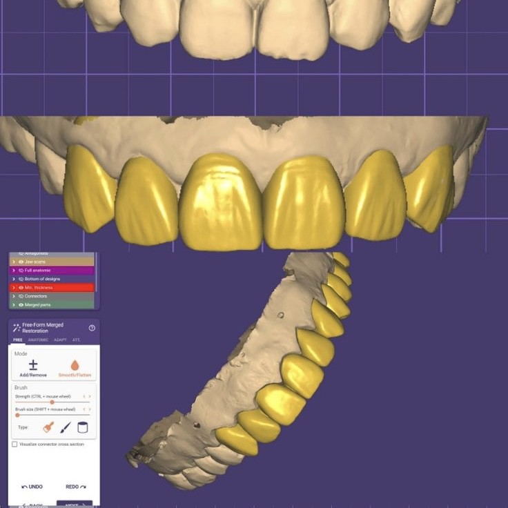 Dental Digital Crown And Bridge Design